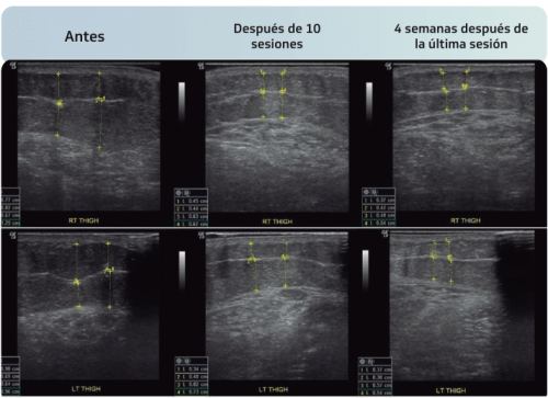 Body-Contouring-Spanish-INDIBA-6-1