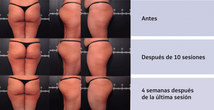 Body-Contouring-Spanish INDIBA-6